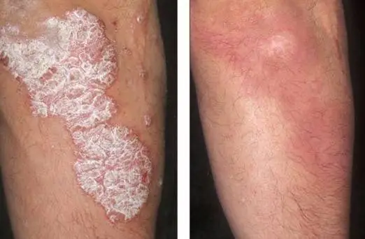 Haloderm Cream For Eczema and Psoriasis